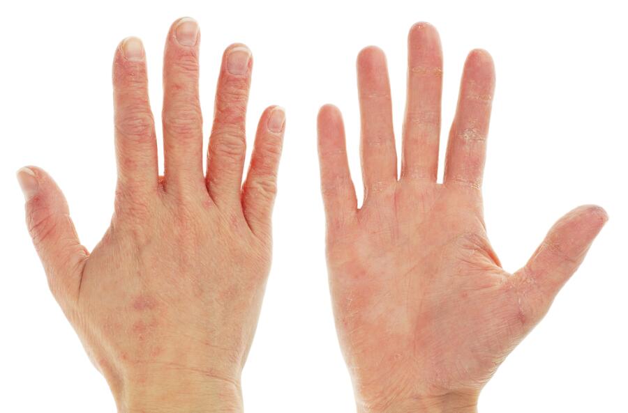 Как лечить трещины на пальцах рук?