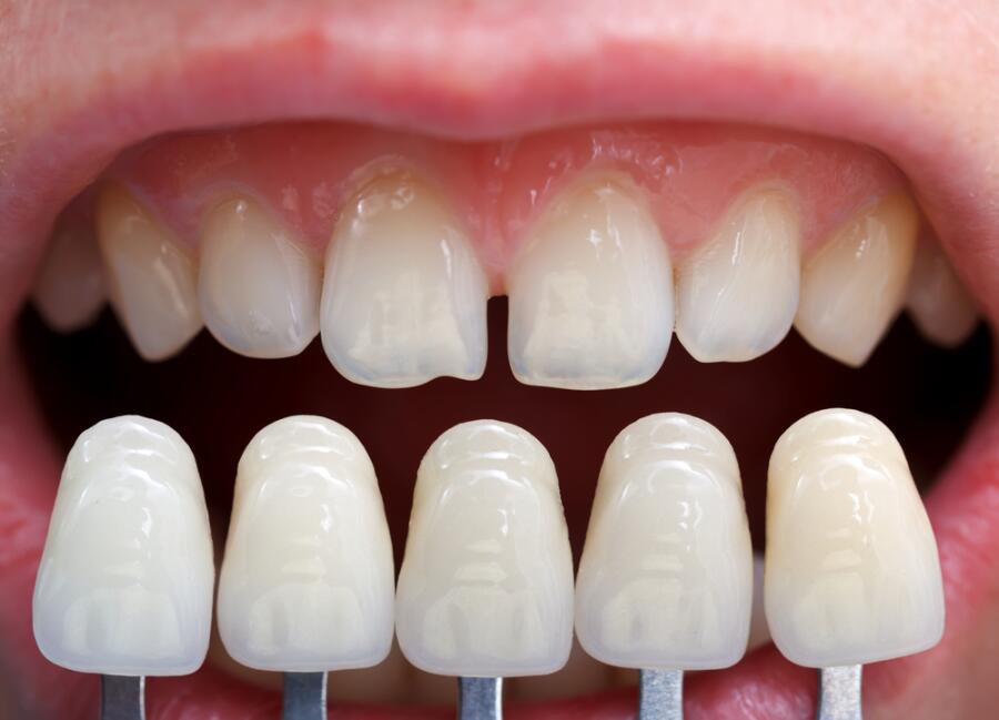 Виниры на зубы. Что известно о художественной реставрации зубов?