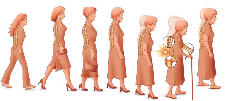 Чем вредна сутулость? Чем вредна сутулость?