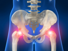 Перелом шейки бедра - одно из основных и наиболее частых осложнений остеопороза