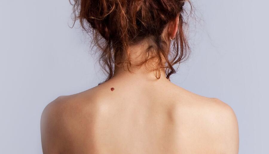 Из каких этапов состоит лазерное удаление родинки?