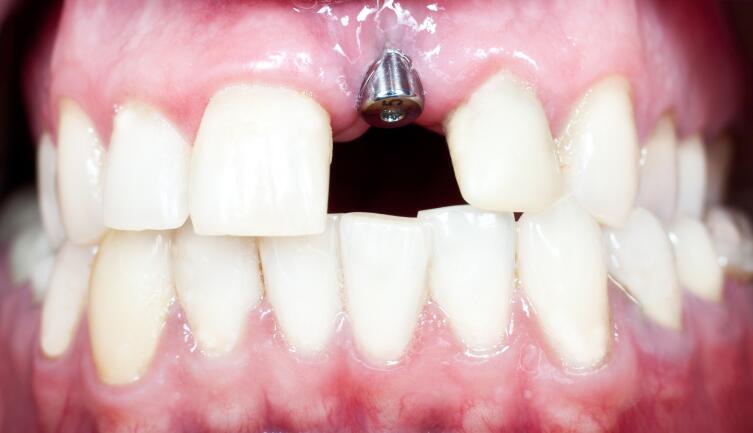 Имплантат закроется коронкой и зуб ничем не будет отличаться от настоящего