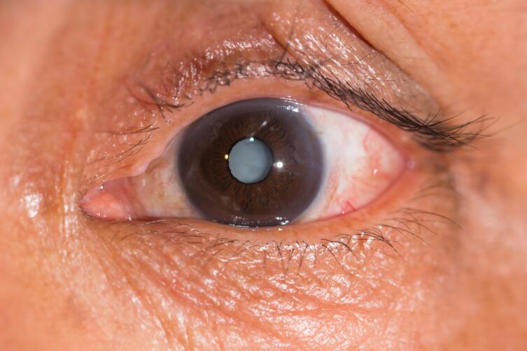 Что такое катаракта?