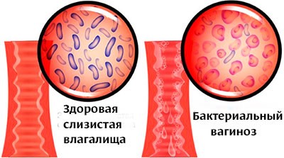 Лечение баквагиноза и молочницы. Все ли может АктиГель?