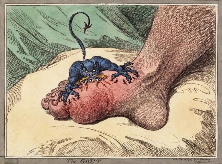 «Подагра». Иллюстрация Джеймса Гилрея, 1799 г. Мастер карикатуры изобразил болевой синдром при подагре как демона или дракона