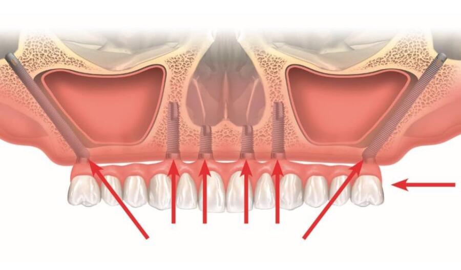Скуловая имплантация верхней челюсти