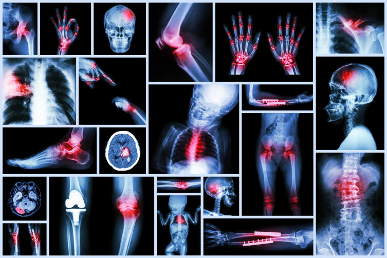 Как диагностируют и лечат переломы костей?