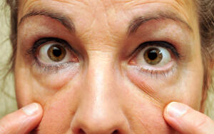 Как удалить мешки под глазами?