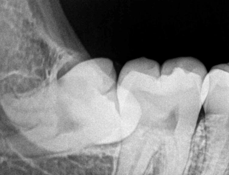 Рентгеновский снимок ретинированного нижнего правого зуба мудрости с горизонтальной ориентацией