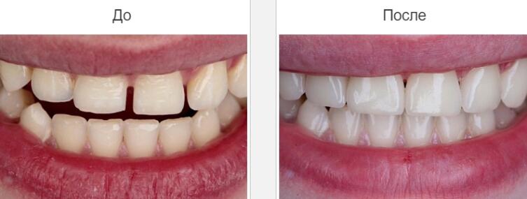 Виды протезирования зубов и их особенности: выбираем качественный протез