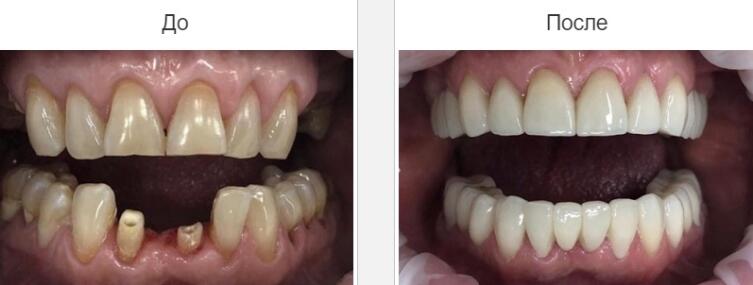 Виды протезирования зубов и их особенности: выбираем качественный протез