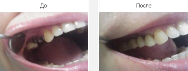 Виды протезирования зубов и их особенности: выбираем качественный протез