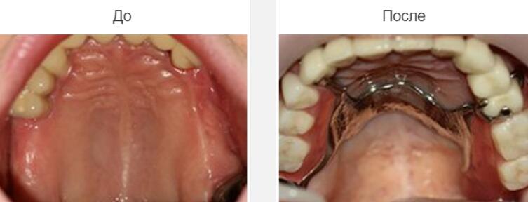 Виды протезирования зубов и их особенности: выбираем качественный протез