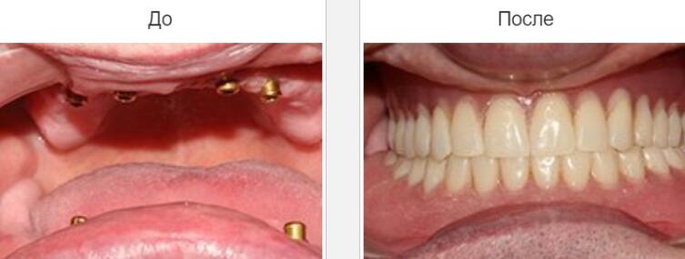 Виды протезирования зубов и их особенности: выбираем качественный протез