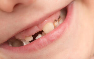 Что нужно знать о детских зубах?