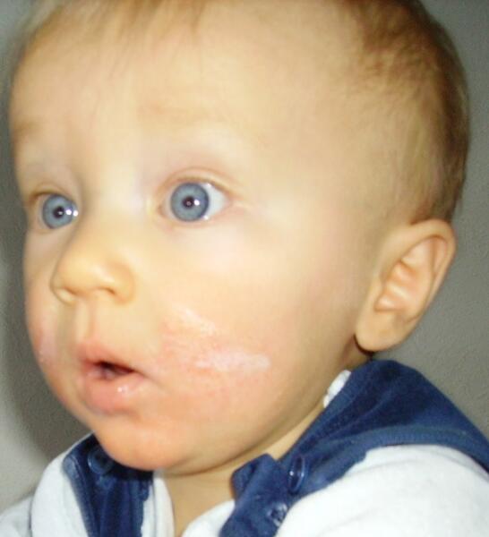 Ребёнок с проявлениями атопического дерматита