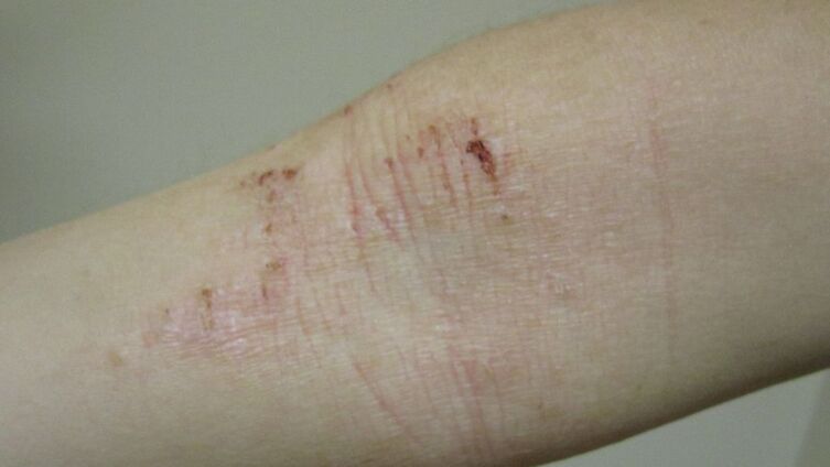Атопический дерматит на коже сгибательной поверхности локтевого сустава. Следы расчёсов и лихенизация кожи