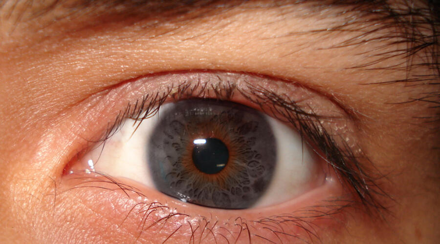 Блефаропластика: как вернуть молодость и красоту глаз
