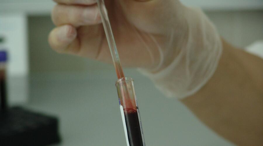 Различие ферритина и гемоглобина при выпадении волос