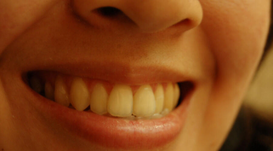 Импланты или съёмный протез: что удобнее, надёжнее и дешевле в перспективе?