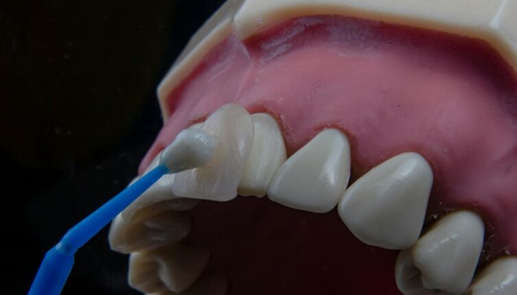 Виниры на зубы. Что известно о художественной реставрации зубов?